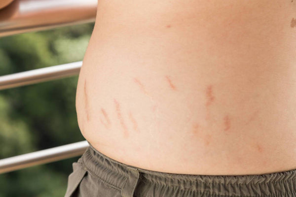 How to get Rid of Stretch Marks for Men - A Man's Guide to Stretch Marks