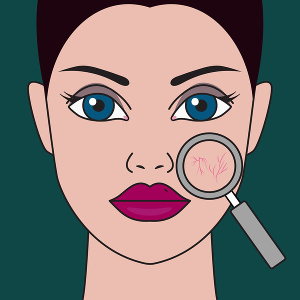 Ocular Rosacea Treatment Guide - Diet, Creams, Medicines and more