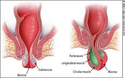 Thrombosed Hemorrhoids 101: A Guide to Thrombosed Hemorrhoids Relief