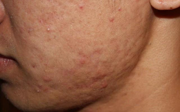 Do Scars Ever Go Away Completely? Find Out if Your Scar Will Go Away