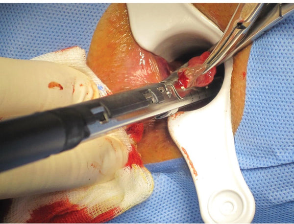 Hemorrhoid Removal Guide 101 - Discover How to Remove Hemorrhoids Fast