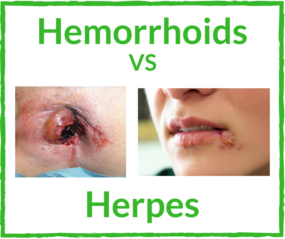 Do you have herpes or hemorrhoids? In this blog post, well discuss the difference between hemorrhoids and herpes in detail. If you have pain and are unsure of which one you have, fear not as we are here to help. What Are Hemorrhoids and Herpes? Hemorrhoids are a cluster of inflamed blood vessels and veins located inside the lower rectal area and outside the anal opening. Everyone has hemorrhoids, as they help transport blood vessels to the needed areas of the rectum, it is only when they become swollen and portray symptoms of inflammation that hemorrhoids become an issue.