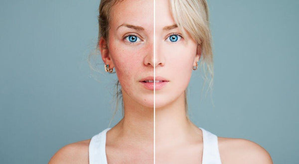 Discover How to Get Rid of Rosacea - Top Rosacea Treatment Tips and Tricks