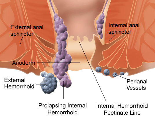 Best Internal Hemorrhoids Treatment Tips & Advice - Internal Hemorrhoid Help!