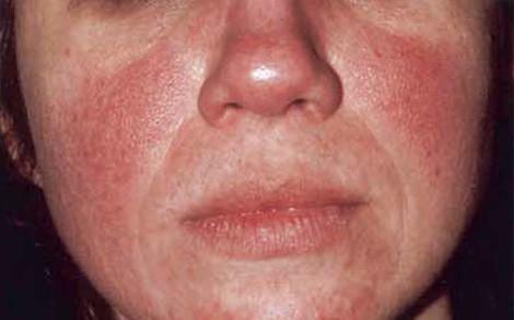 Rosacea 101: The Anatomy of Rosacea