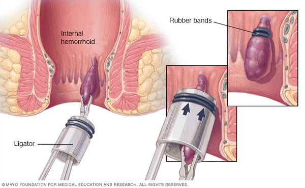 Rubber Band Ligation - Everything You Need to Know about Hemorrhoid Banding