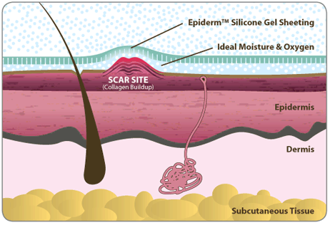 Scars 101: The Anatomy of a Scar - Scarring Definition, Tips and Advice