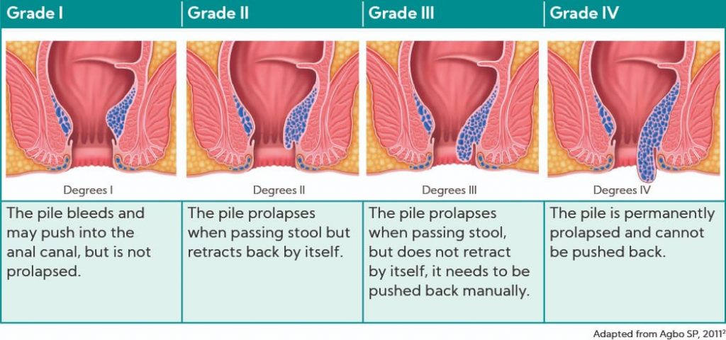 Will Hemorrhoids Go Away on Their Own?