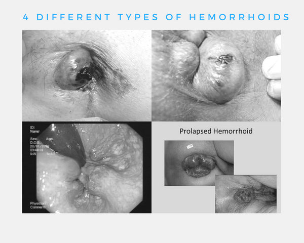 The 4 Different Types of Hemorrhoids and What You Must Know About Each One