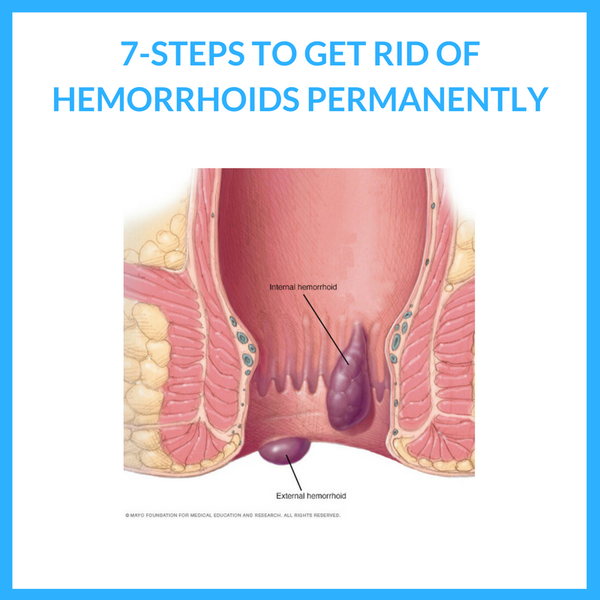 How to Get Rid of Hemorrhoids Permanently - 7 Quick and Easy Steps