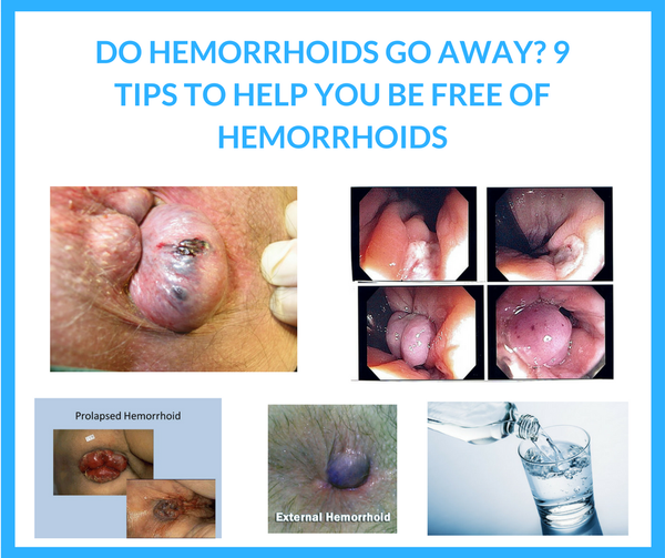 Do Hemorrhoids Go Away? 9 Tips To Help You Be Free Of Hemorrhoids