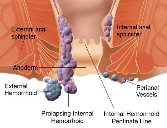 5 Quick Tips That Every Internal Or External Hemorrhoid Sufferer Needs To Know