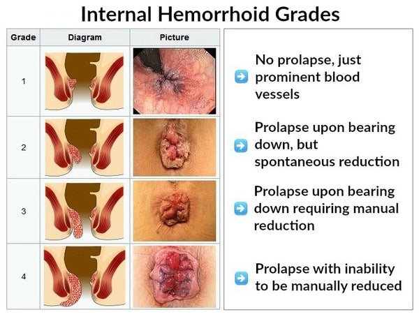 Grade 4 Hemorrhoid Guide: Treatment, Options, Reviews & Information