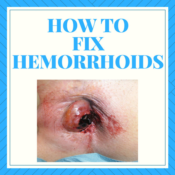 How to Fix Hemorrhoids Fast, Naturally and Safely - External, Internal, Prolapsed & Thrombosed