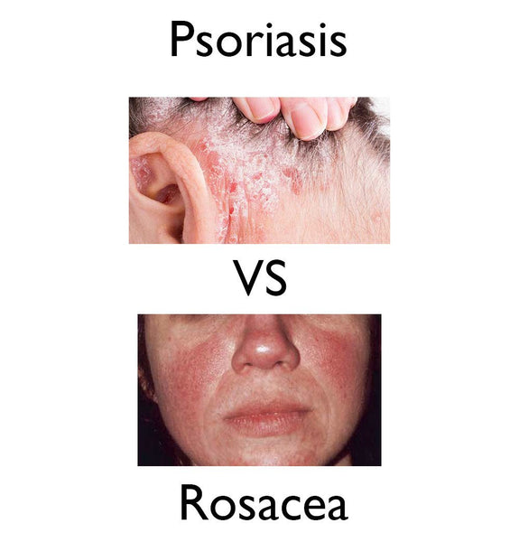 Psoriasis vs Rosacea? Do I Have Psoriasis or Rosacea? Discover the Truth Now!