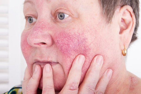 Best Essential Oils for Rosacea - Which Essential Oils Are the Best for Rosacea?