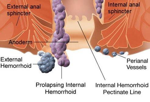 Hemorrhoids Guide: Treatment, Symptoms and Relief For Internal and External Hemeroids