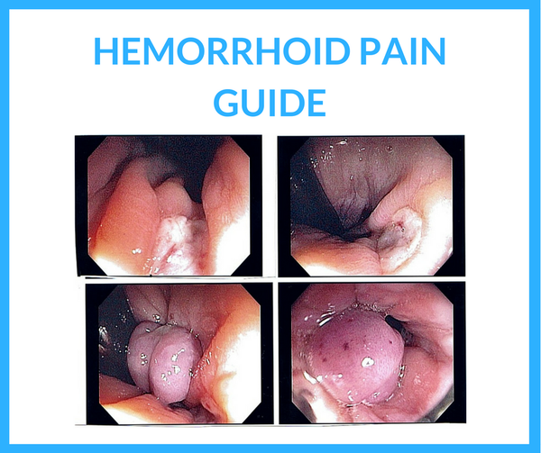 Hemorrhoid Pain 101: A Guide to Dealing with Severe Hemorrhoid Pain