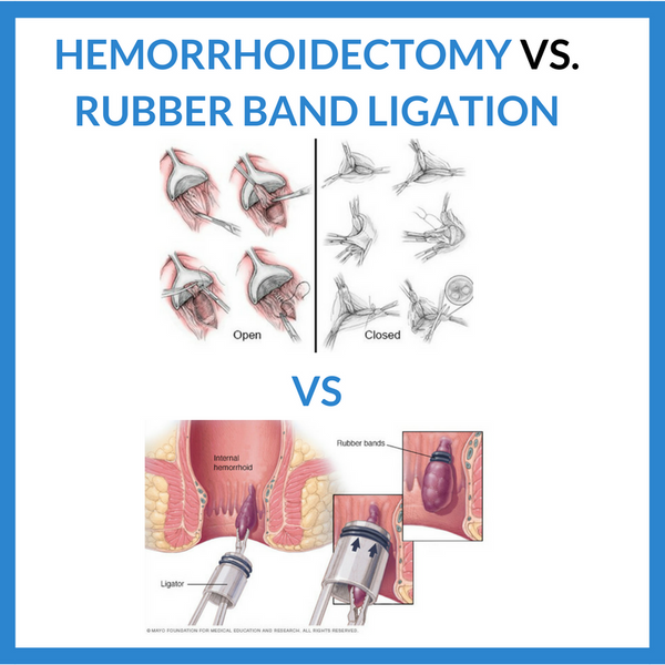 Hemorrhoidectomy vs Rubber Band Ligation (Banding) Reviews & Cost Comparison