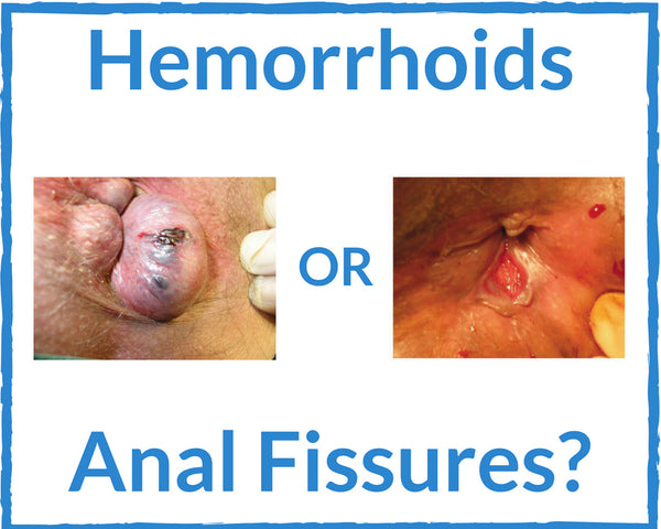 Hemorrhoid Fissure Guide - The Difference Between Hemorrhoids and Fissures
