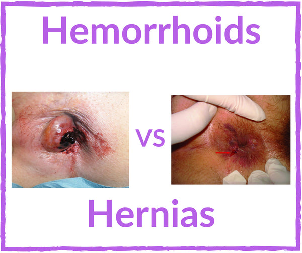 Hernia vs Hemorrhoids Guide - Do I Have A Hernia or Hemorrhoids Discover the Truth?