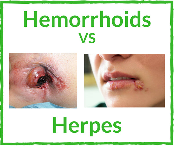 Hemorrhoids vs Herpes - Discover If You Have Hemorrhoids or Herpes!