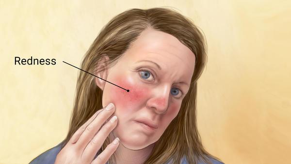 How To Stop Rosacea From Itching | What Causes Rosacea to Itch?