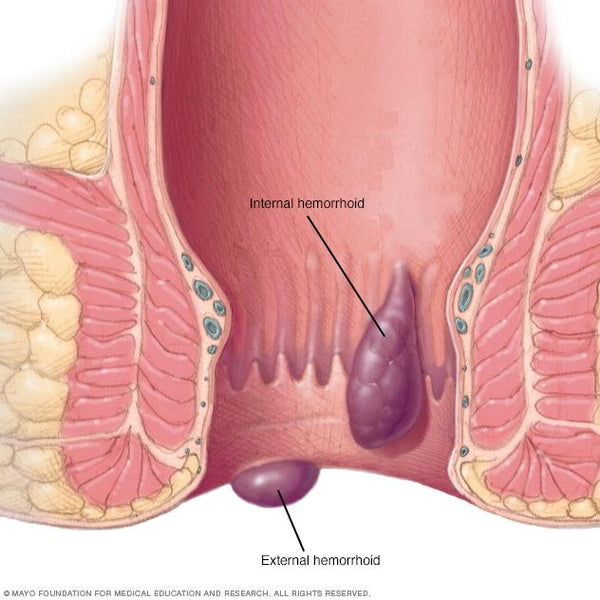 How to Cure Hemorrhoids at Home Fast & Permanently