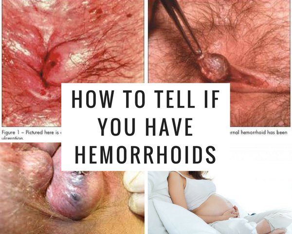 How to Tell if You Have Hemorrhoids - Do You Have Hemorrhoids?