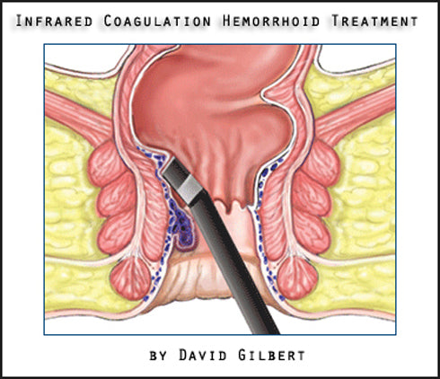 Infrared Coagulation Therapy – Does IRC Really Work for Hemorrhoids?
