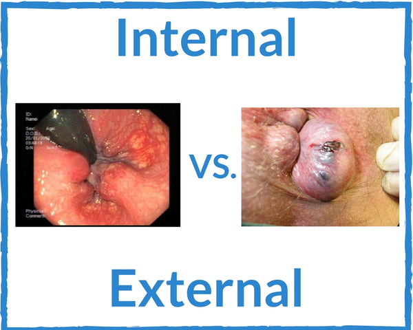 Internal Vs External Hemorrhoids - Do I have Internal or External Hemorrhoids?