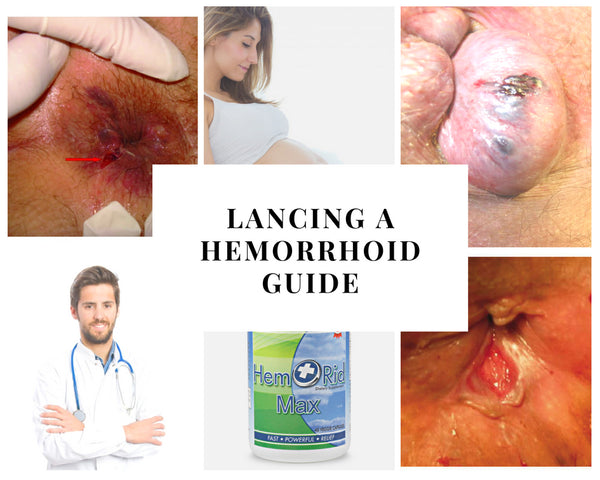 Is Lancing a Hemorrhoid Safe? Discover the How to Drain Hemorrhoids