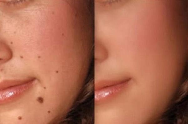 Mole Removal Scar Guide: The Most Effective Methods of Treatment