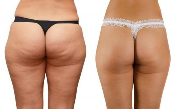 The Myths and Facts About Cellulite